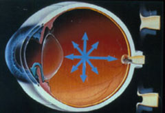 17_02-glaucoma